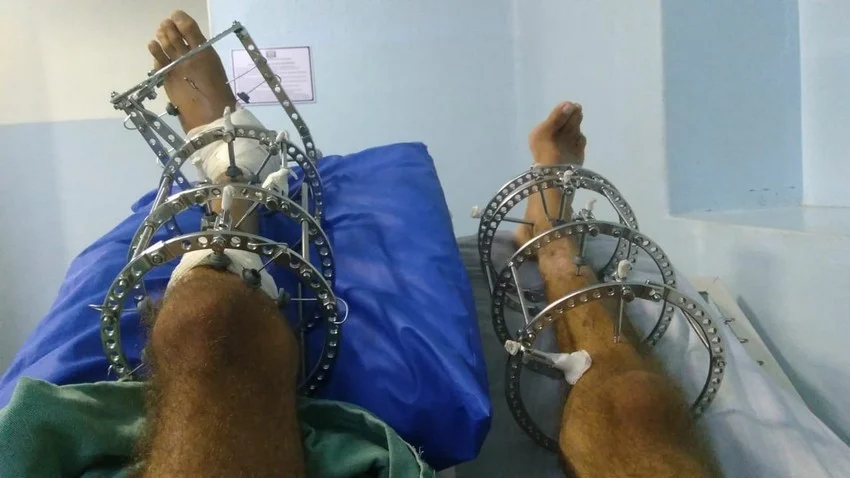 Após risco de vida e de amputação, paciente da saúde pública de Resende é recuperado com trabalho em equipe
